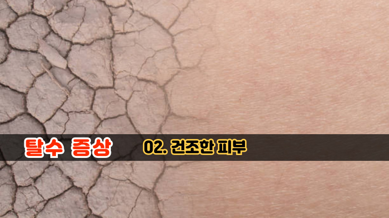 02. 건조한 피부